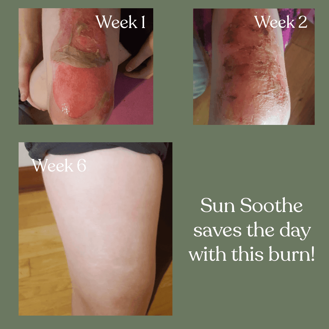 Before and after progression showing severe sunburn healing over 6 weeks with Sun Soothe salve treatment